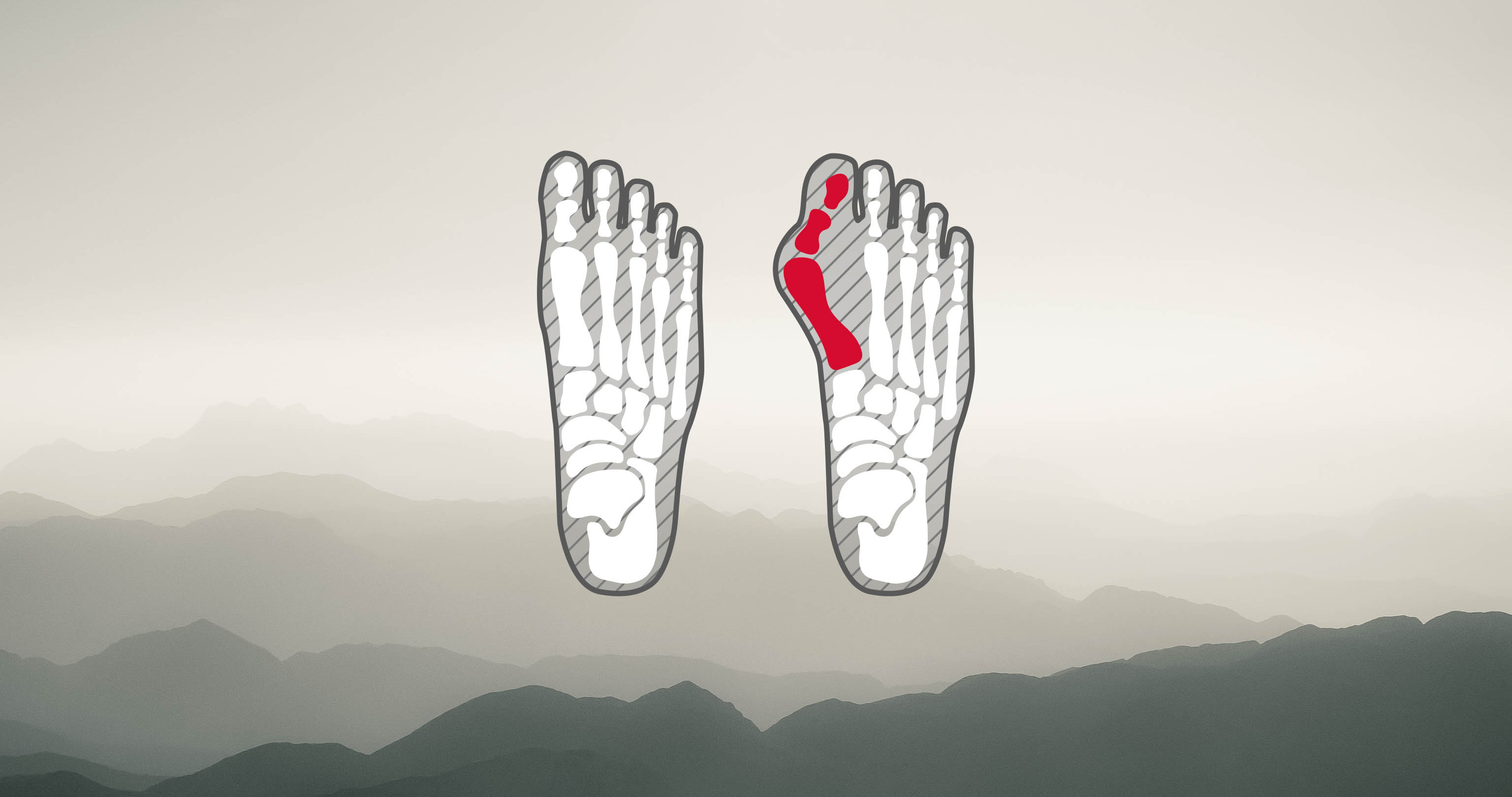 Illustration of Feet with Bunions